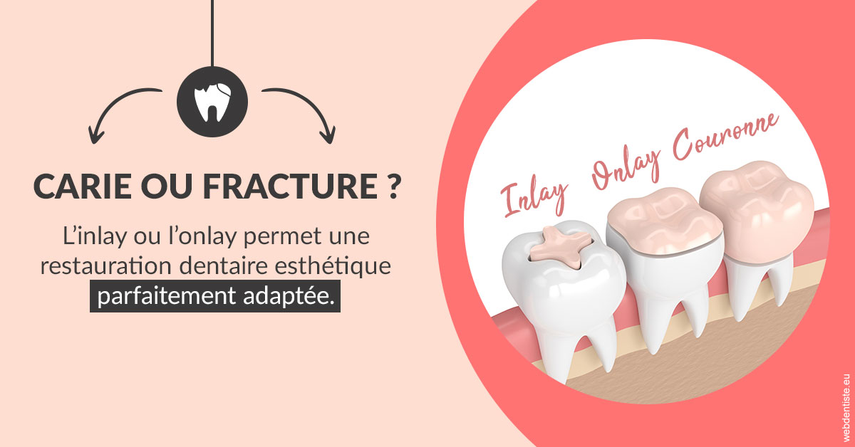 https://dr-tavel-vanessa.chirurgiens-dentistes.fr/T2 2023 - Carie ou fracture 2