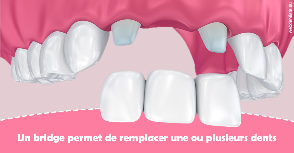 https://dr-tavel-vanessa.chirurgiens-dentistes.fr/Bridge remplacer dents 2