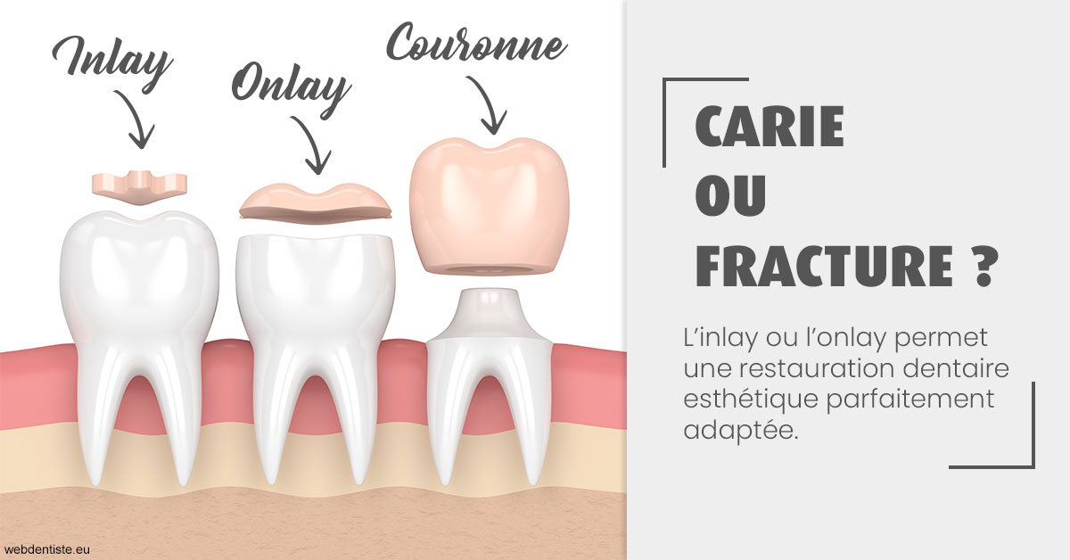 https://dr-tavel-vanessa.chirurgiens-dentistes.fr/T2 2023 - Carie ou fracture 1