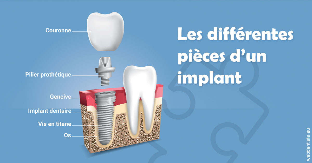 https://dr-tavel-vanessa.chirurgiens-dentistes.fr/Les différentes pièces d’un implant 1