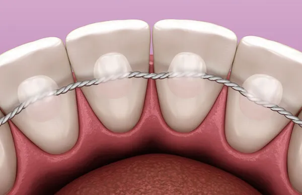 Les sept familles d’appareillages orthodontiques : les appareils de contention